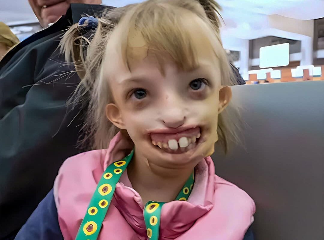 Acid Factory Incident Changes Young Girl’s Life Forever