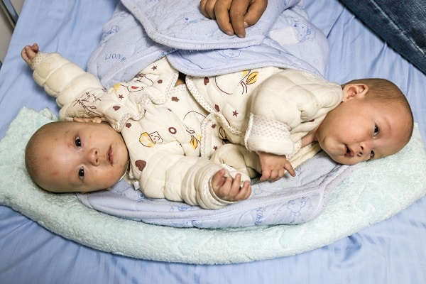 Sidra Medicine Conjoined Twins Tamim Hamad image courtesy Carl Sulit