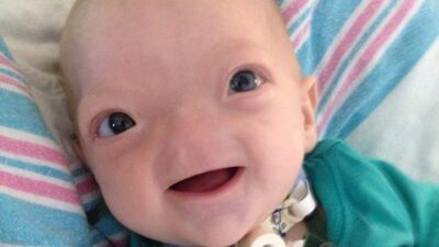 Pregnancy Complications Led to Baby Born Without Nose