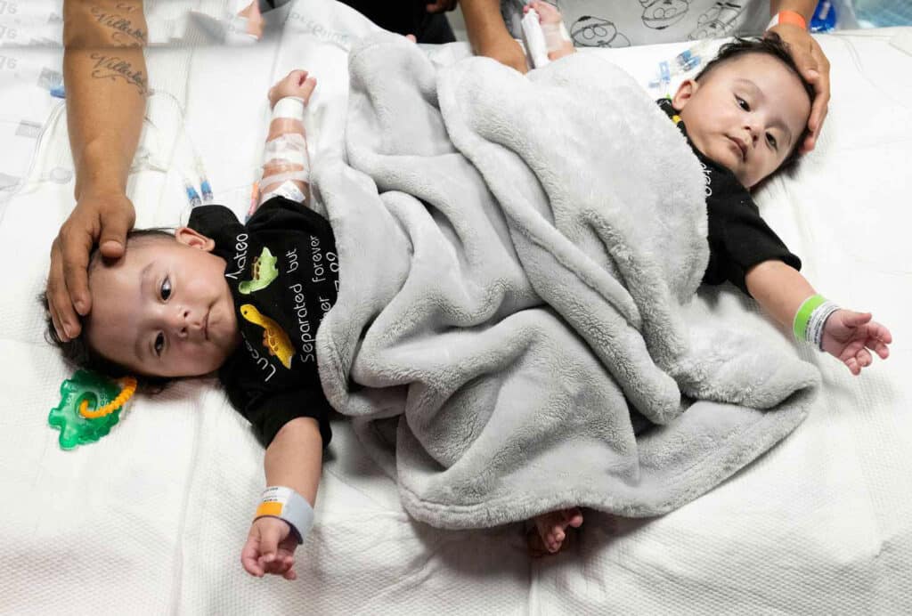 lucas mateo villalobos barrera conjoined twins 071823 9 220f752c5d194488a915c6ebbd78e108